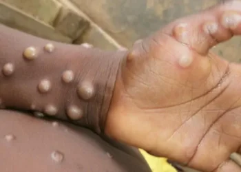Santé: un premier cas confirmé de Mpox en Guinée